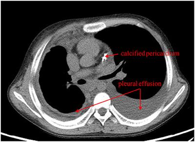 Case Report: Protein-Losing Enteropathy in Association With Tuberculosis-Related Constrictive Pericarditis